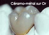 ceramo metal sur or